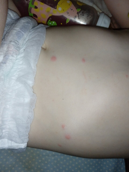 Аллергия?