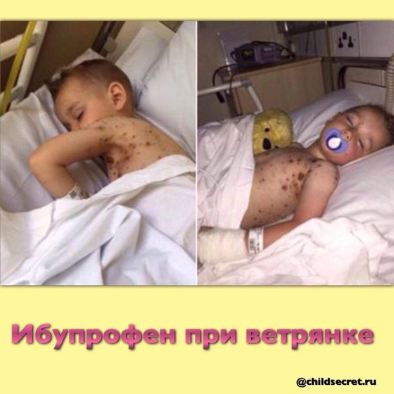 Ибупрофен при ветрянке