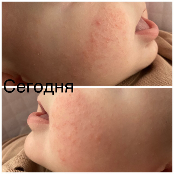 Бесконечная аллергия 😫🤯😵💫