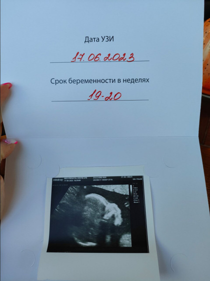 Второй скрининг.