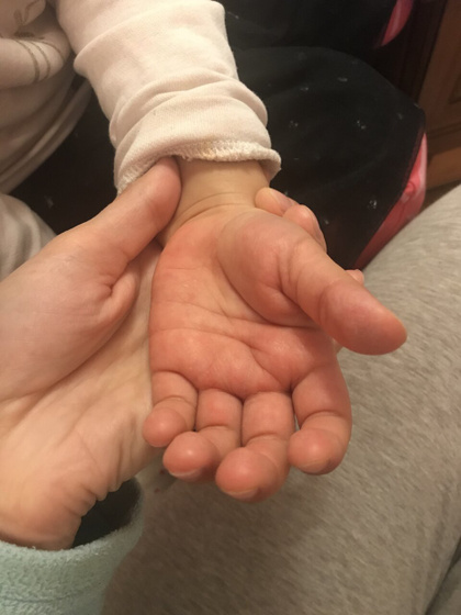 Красные ладошки и зуд у ребёнка