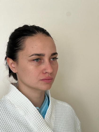 Подтяжка лба ☺️