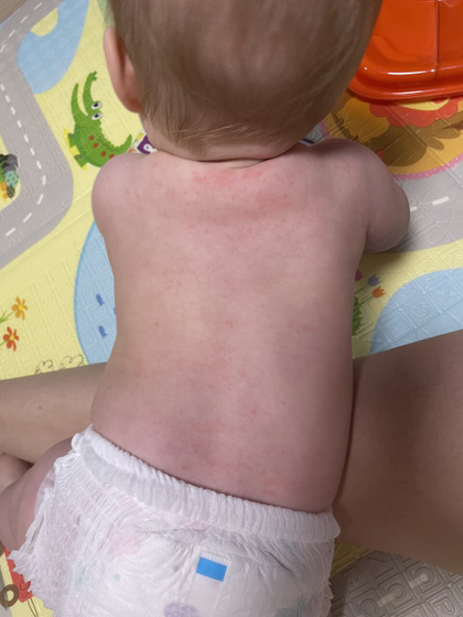 У кого у деток была розеола? Это оно? Или потничка? Или аллергия?