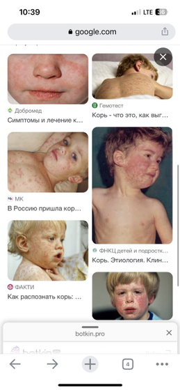 Корь