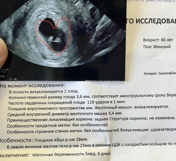Первое УЗИ ❤️