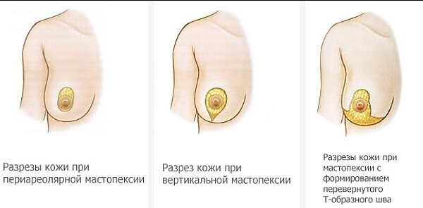Кто делал подтяжку груди,