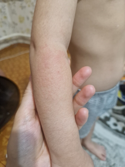 Сыпь