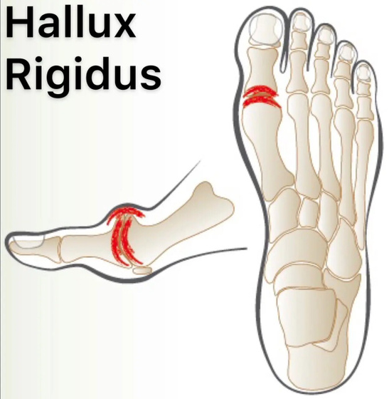 hallux rigidus Косточка на стопе, может кому ставили такой диагноз?