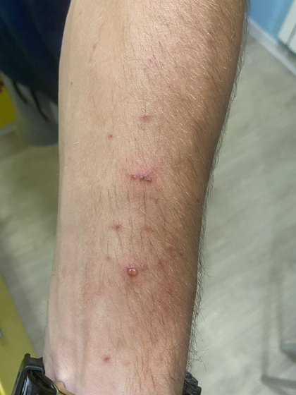 Сыпь у взрослых