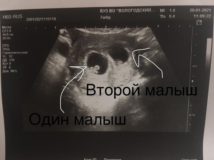Первое плановое УЗИ после ЭКО.