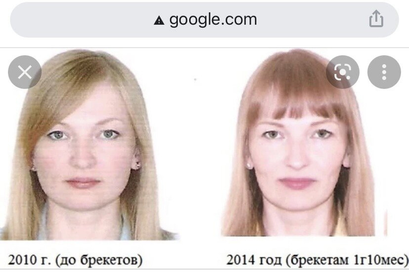Хочу брекеты очень ,