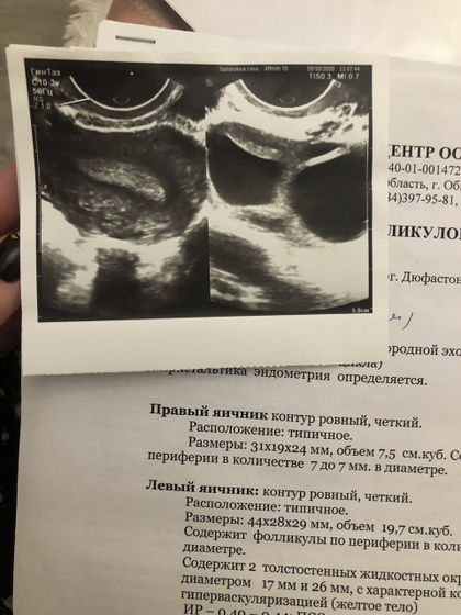 Овуляция(СПКЯ?), дюфастон