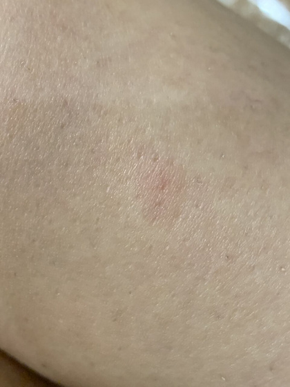 Укус или паранойя?