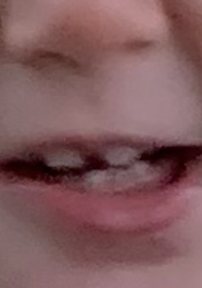 Передние зубы