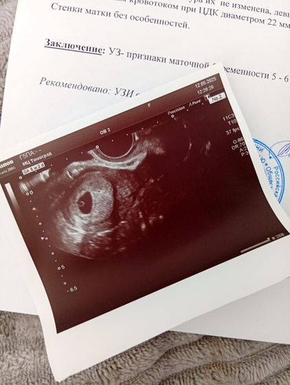УЗИ (5 недель 2 дня)