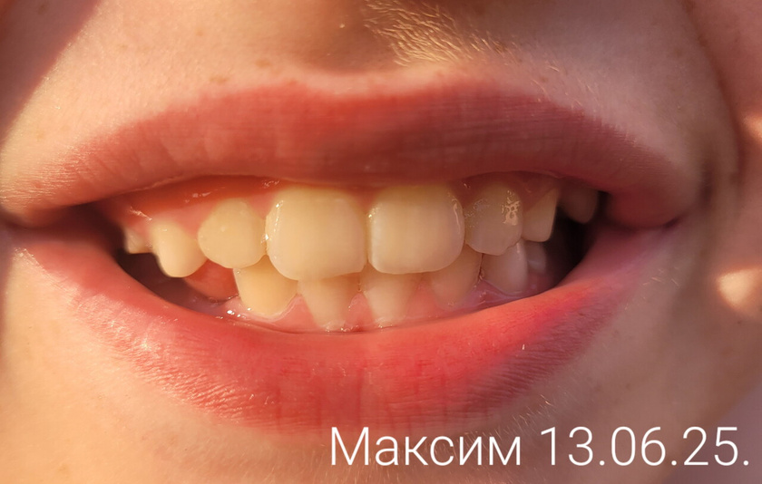 Ортодонтическая пластина
