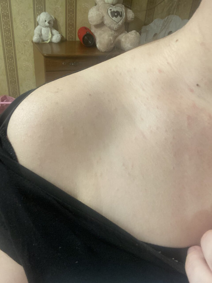 Увидела у себя сыпь