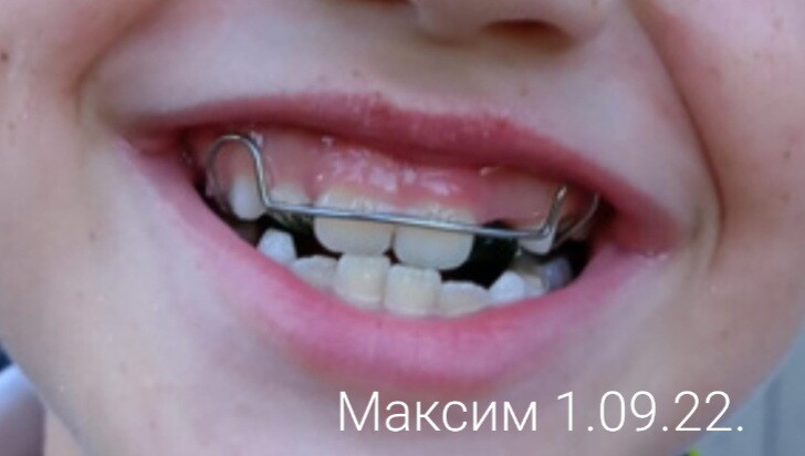 Ортодонтическая пластина