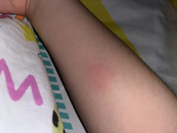 Девочки, сделали вчера манту🤦🏻♀️больше