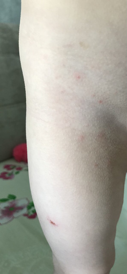 Сыпь. Что это?