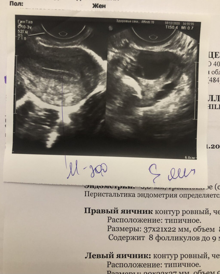 Овуляция(СПКЯ?), дюфастон