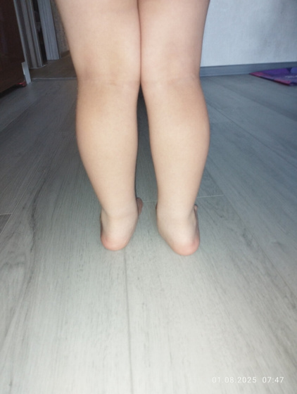 Вальгус 👣