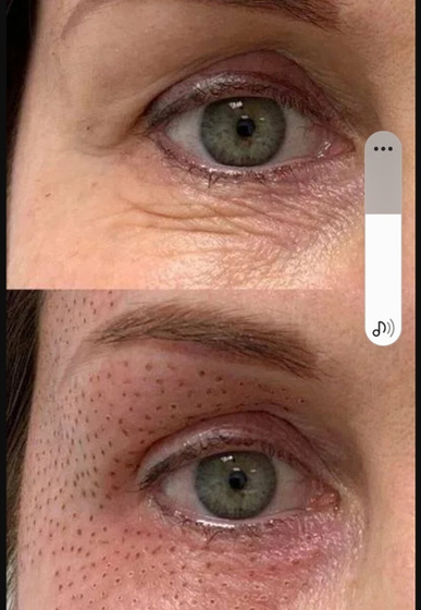 Безоперационная блефаропластика Jett Plasma Lift Medical