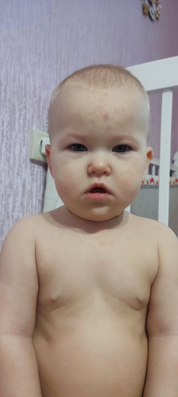 Аллергия?