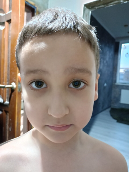Есть ли косоглазие