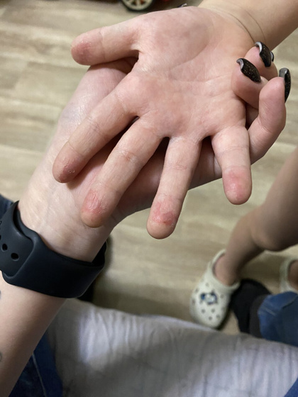 Красные пятна на пальцах
