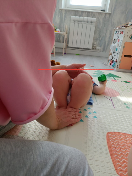 Одна нога длинней другой у ребенка