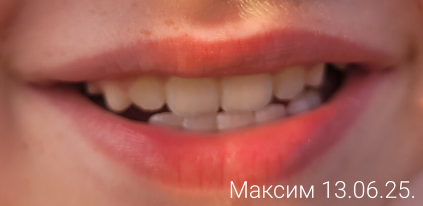 Ортодонтическая пластина