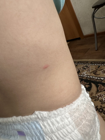 Девочки, дочь переболела ветрянкой