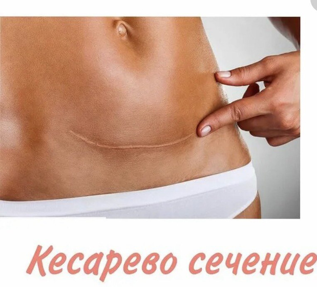 А я всё о кс. (Предыдущий пост и первые роды ЕР)...
