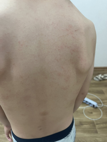 Сыпь