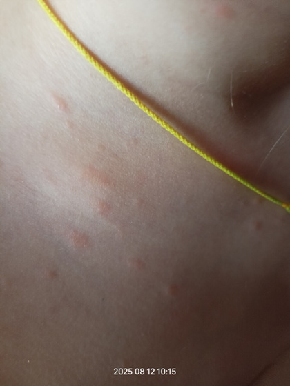 Что за сыпь? Есть немного на руках и спине. Не розовый лишай?