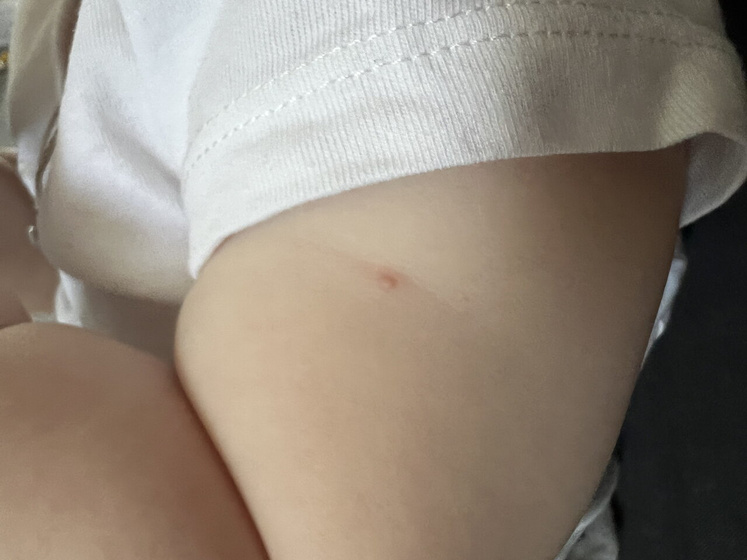 Прыщик или что это? БЦЖ