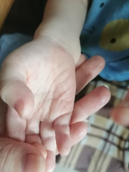 Красные прыщики на ладонях