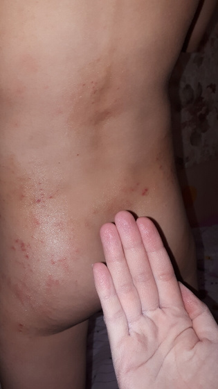 Атопический или что ,врач ошибается??😔😥