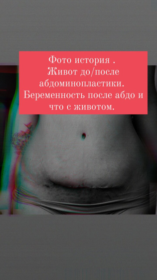 Готова поделиться всеми фото. Как закончилась беременность после абдоминопластики