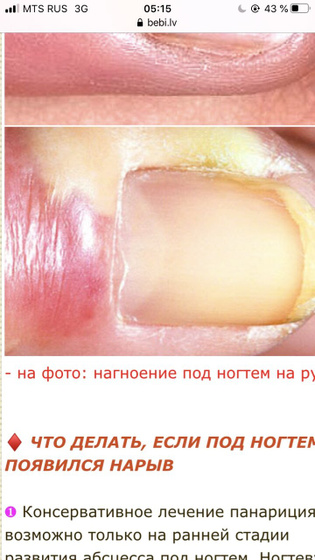 Жутко болит большой палец