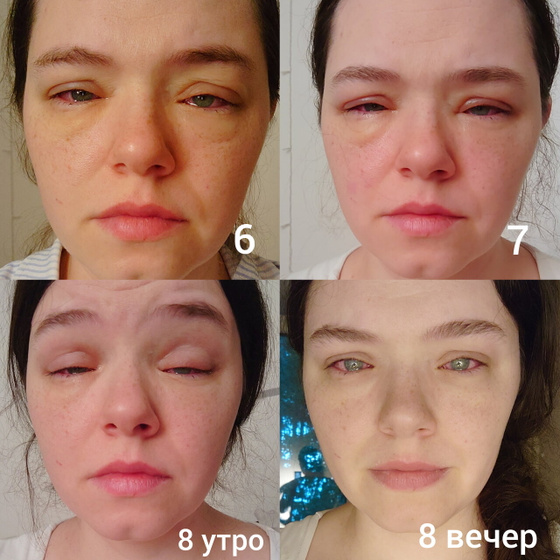 Как я почти ослепла на 5 дней