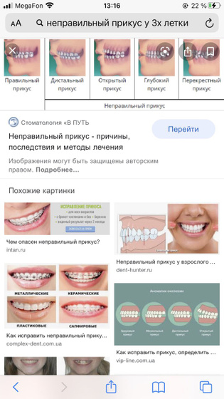 Неправильный прикус