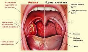 Ангина, но какая? Вирусная или бактериалтная?
