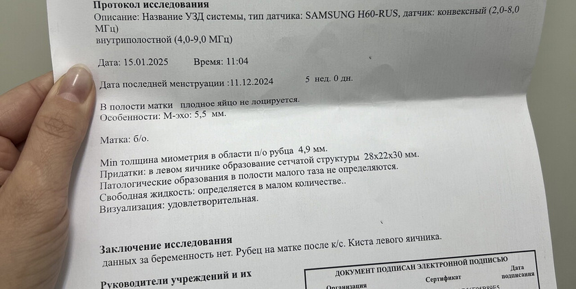 уЗИ киста ЖТ
