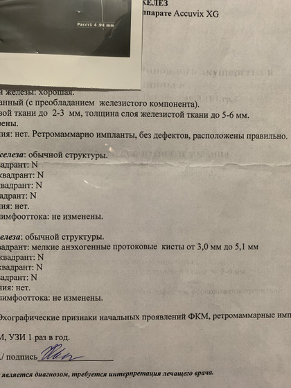 Кисты. молочные железы