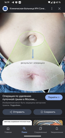 Грыжа