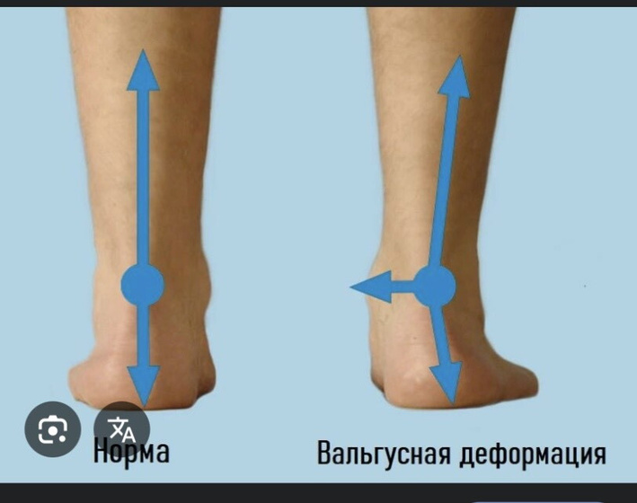 Вальгус
