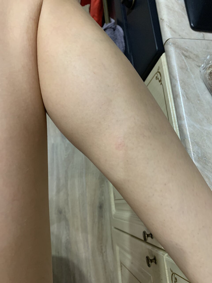 Укус или паранойя?