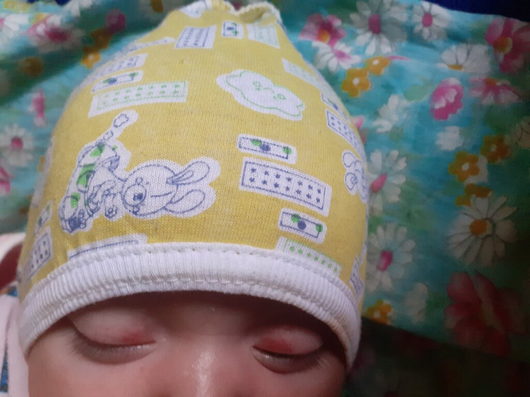Покраснение на глазах